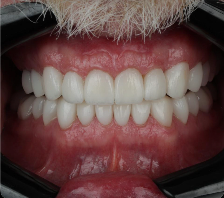 Antes y después diseño de sonrisa Cali — caso 1, después