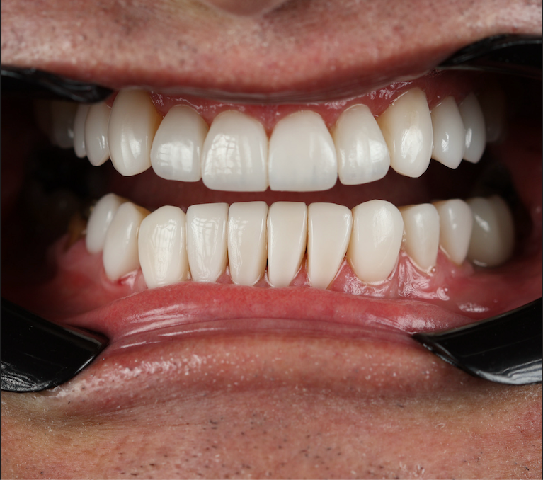 Antes y después diseño de sonrisa Cali — caso 2, después