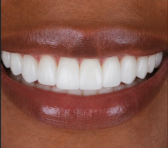 Antes y después diseño de sonrisa Cali — caso 3, después